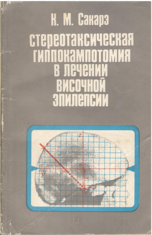 стереотаксическая гиппокампотомия в лечении височной эпилепсии