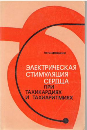 Электрическая стимуляция сердца при тахикардиях и тахиаритмиях