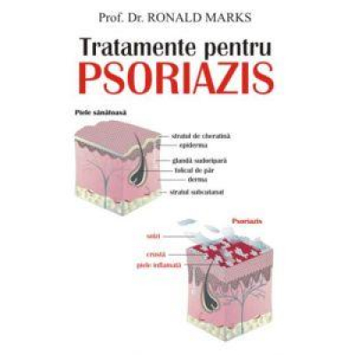 Tratamente pentru psoriazis
